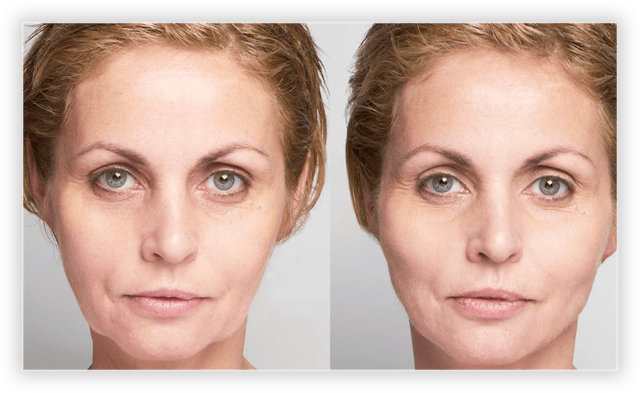Non Surgical Facelift 2